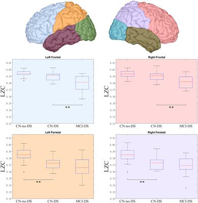 Brain signal complexity in adults with Down syndrome: Potential application in the detection of mild cognitive impairment